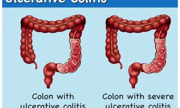 best doctor for ulcerative colitis in Hyderabad