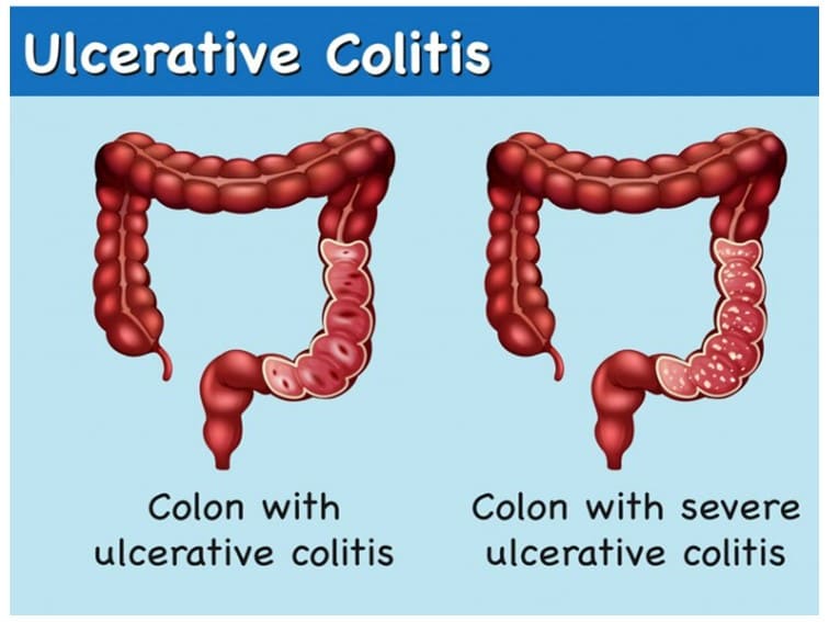 best doctor for ulcerative colitis in Hyderabad