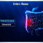 Crohn's Disease symptoms