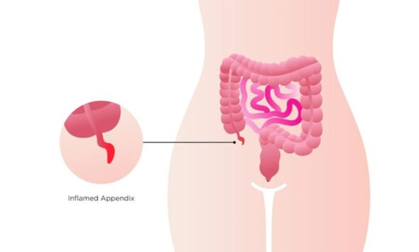 appendicitis causes