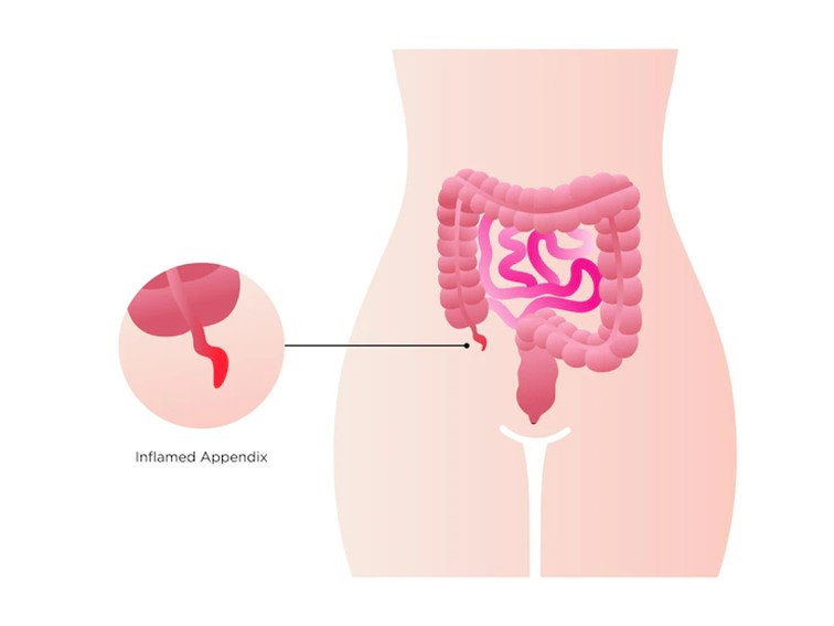 Donde esta la apendicitis mujer