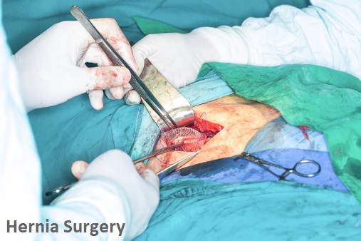 hernia surgery in Hyderabad