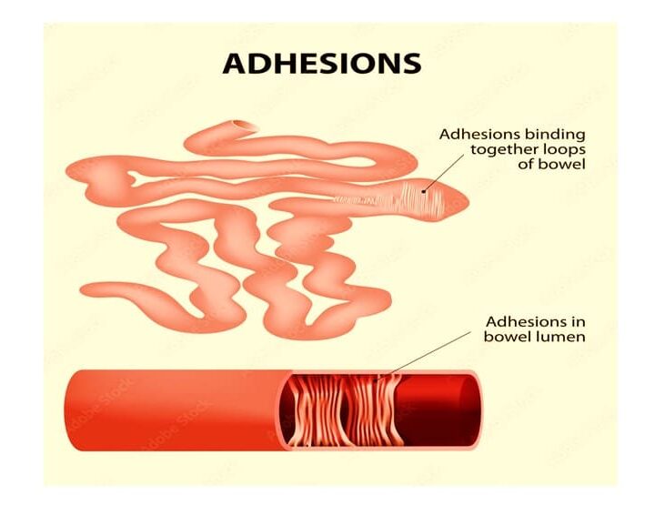 abdominal adhesions causes