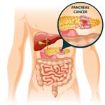 pancreatic cancer treatment